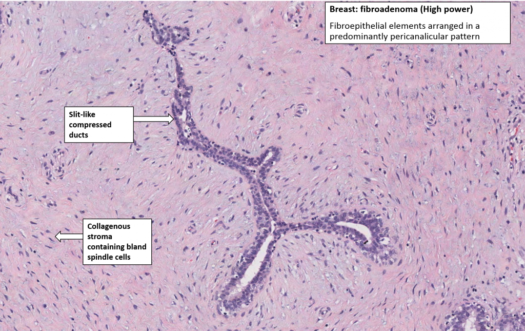 Breast Fibroadenoma Nus Pathweb Nus Pathweb