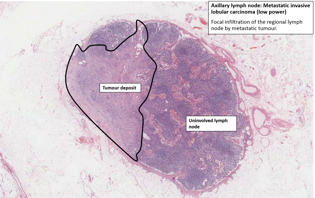 Breast Carcinoma NUS Pathweb NUS Pathweb