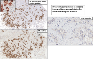 Breast Carcinoma Nus Pathweb Nus Pathweb