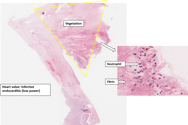 Heart Infective Endocarditis NUS Pathweb NUS Pathweb