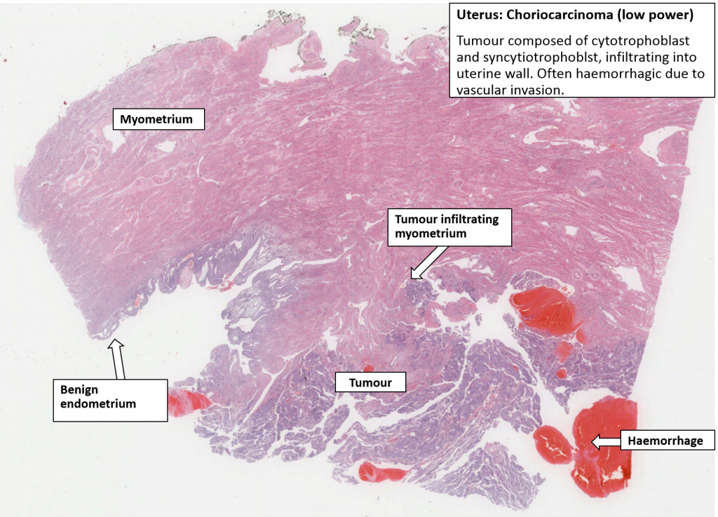 Uterus Choriocarcinoma NUS Pathweb NUS Pathweb