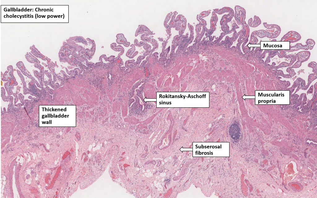 Gallbladder Chronic Cholecystitis Nus Pathweb Nus Pathweb The Best