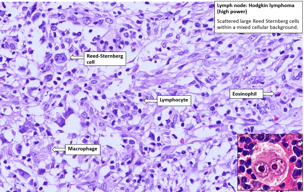 Lymph Node Hodgkin Lymphoma Nus Pathweb Nus Pathweb