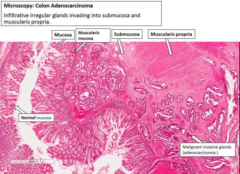 V Neoplasia Media Gallery Nus Pathweb Nus Pathweb