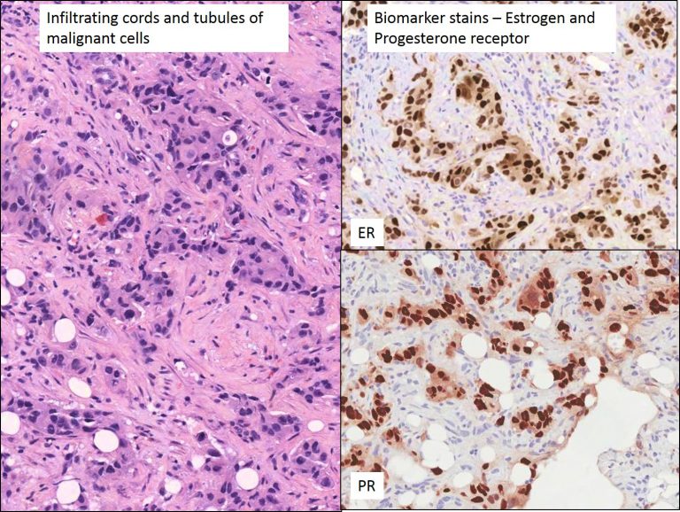 Pathology In Action A Breast Lump Nus Pathweb Nus Pathweb