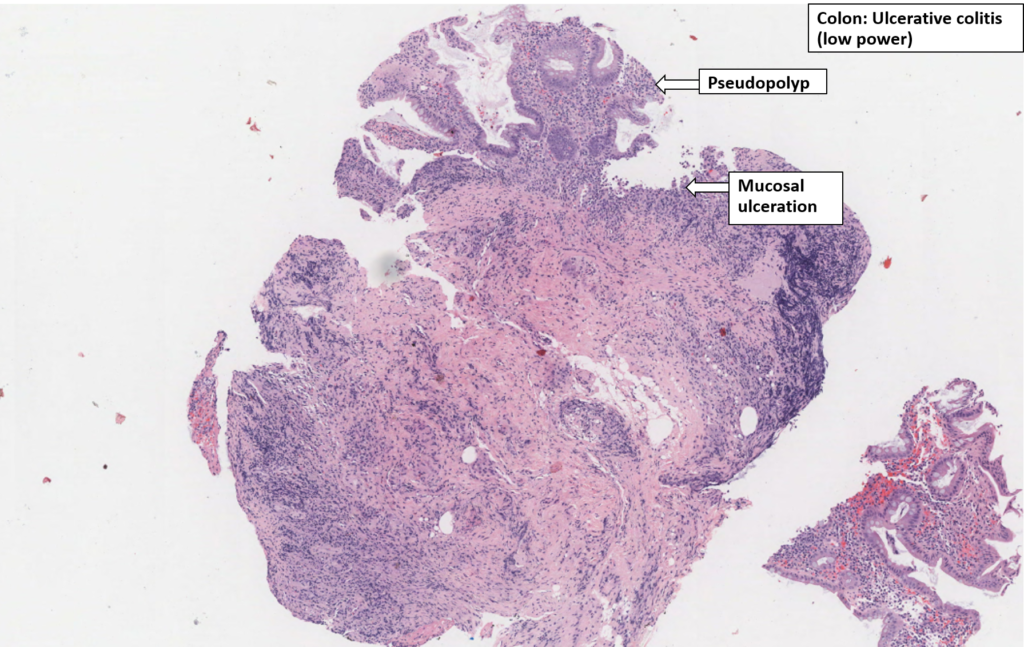 Colon Ulcerative Colitis NUS Pathweb NUS Pathweb