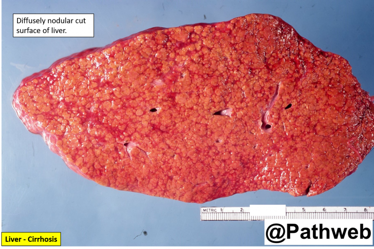 Liver With Oesophagus Cirrhosis With Oesophageal Varices Nus