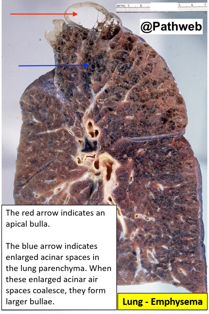 Lung Emphysema NUS Pathweb NUS Pathweb