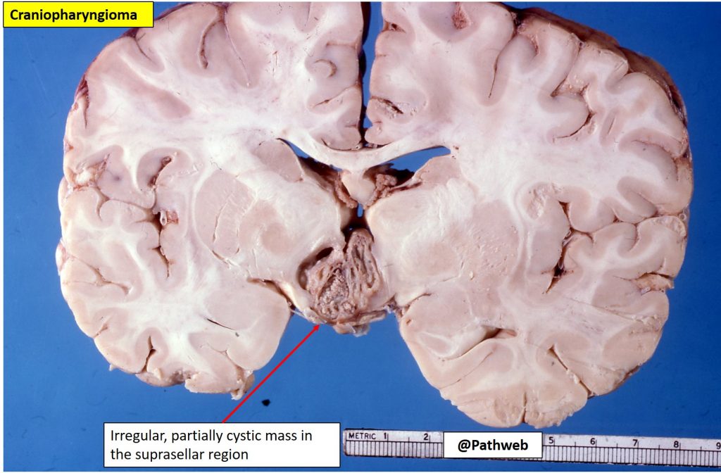 Brain Craniopharyngioma NUS Pathweb NUS Pathweb