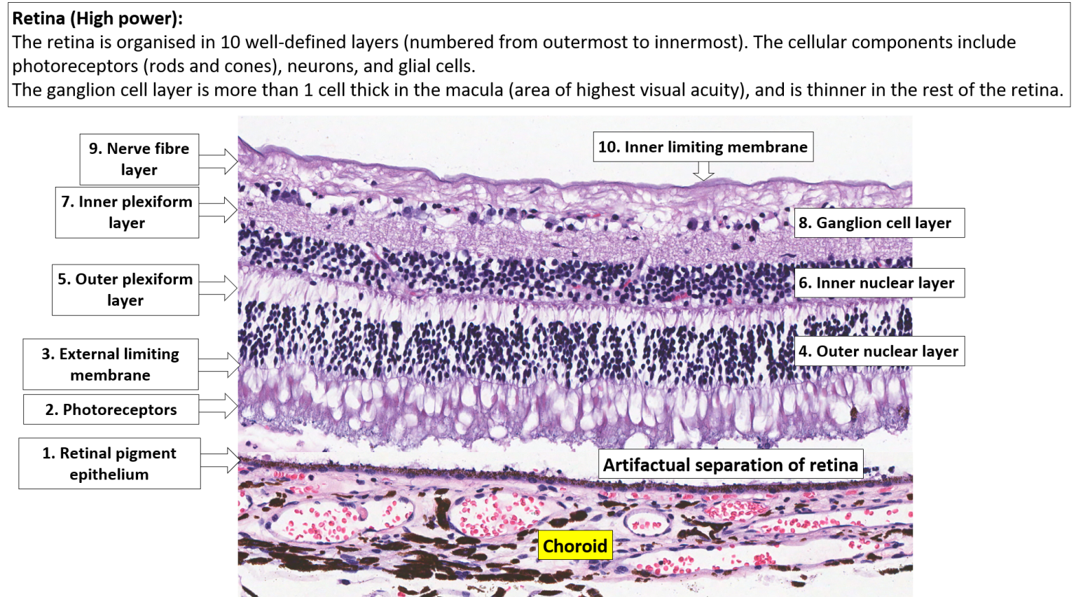 Eye Retina Choroid And Sclera Nus Pathweb Nus Pathweb