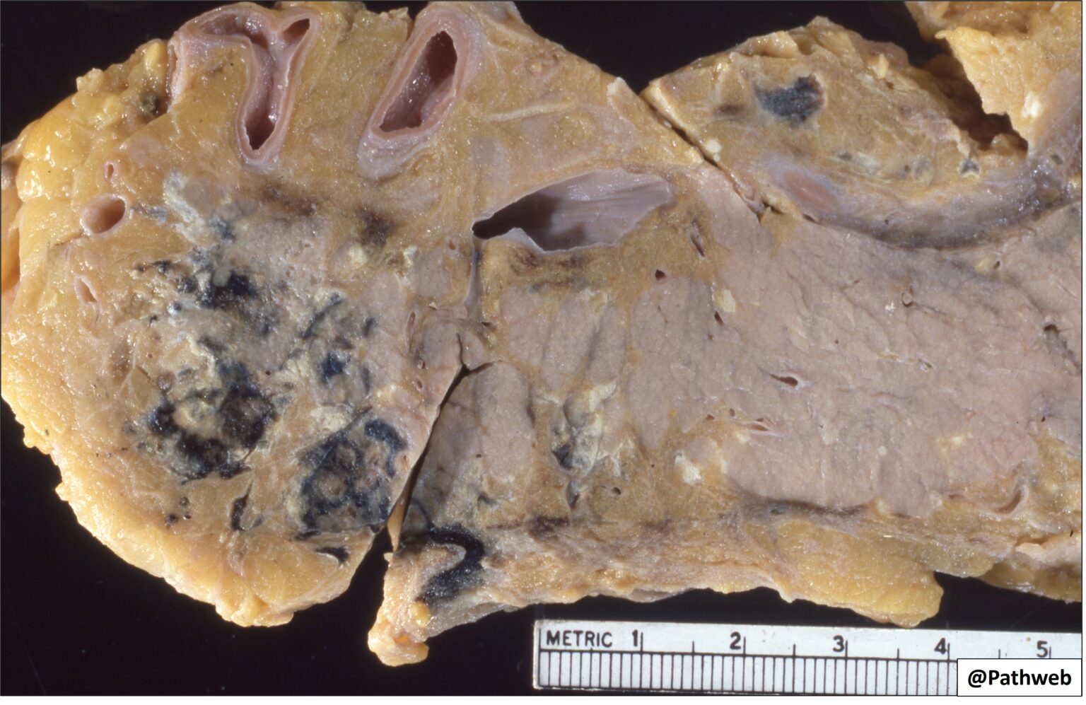 Pancreas Acute Haemorrhagic Pancreatitis NUS Pathweb NUS Pathweb