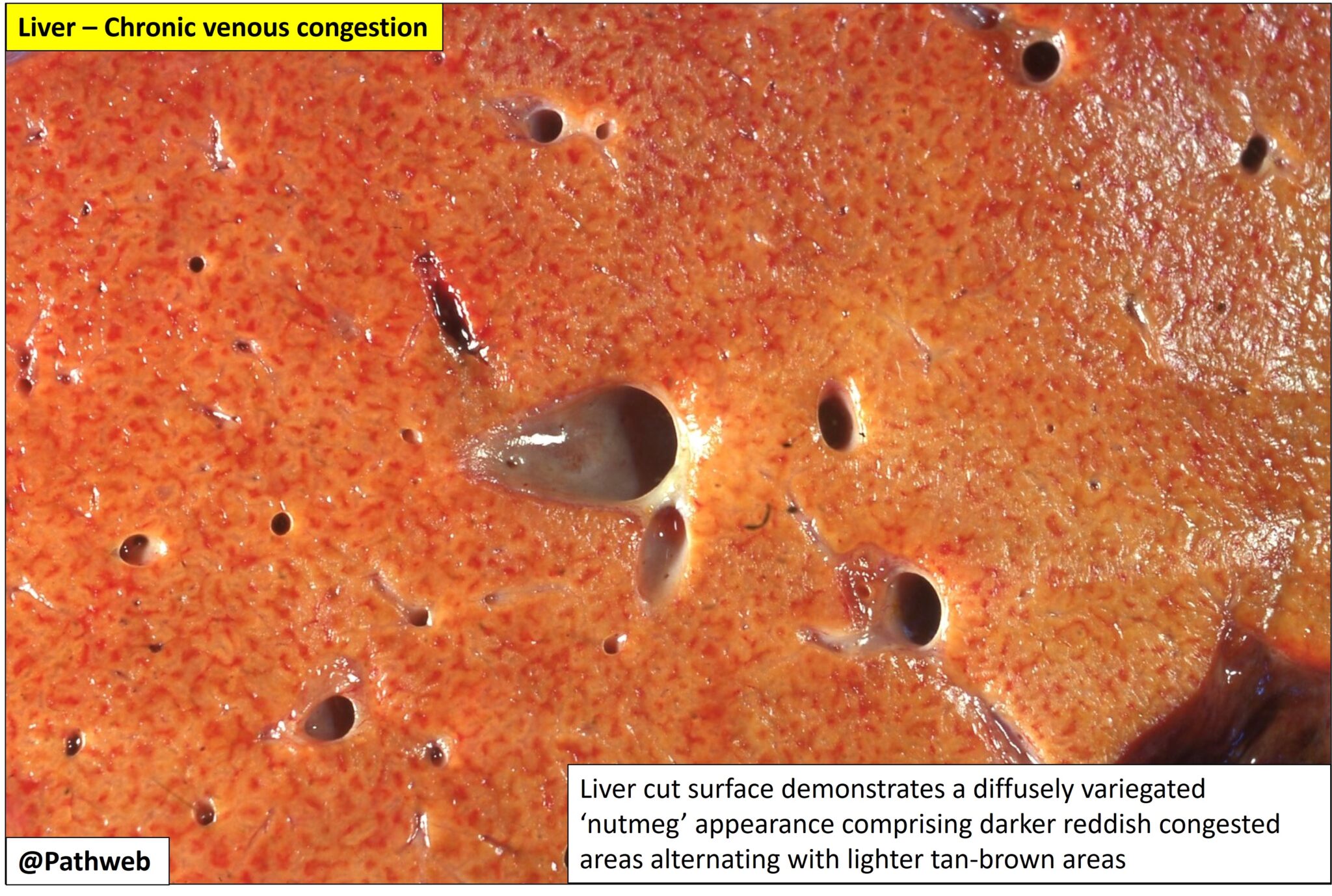 Liver Chronic Venous Congestion Nus Pathweb Nus Pathweb