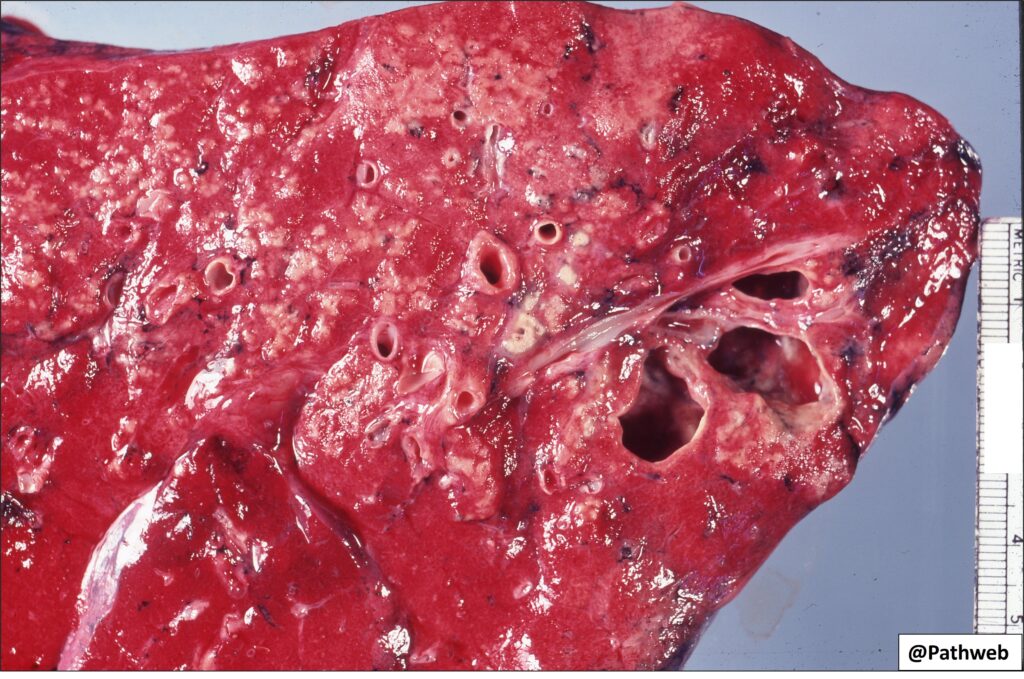 Lung Tuberculosis NUS Pathweb NUS Pathweb