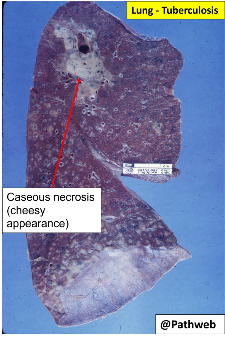 Lung And Larynx Tuberculosis Nus Pathweb Nus Pathweb