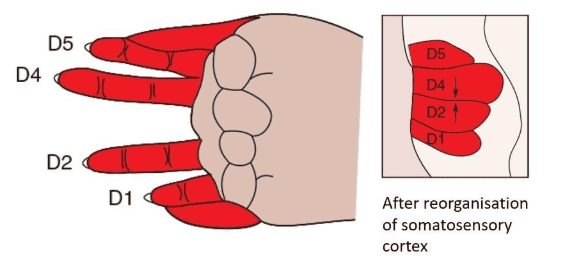 C. Reorganisation of Cortical Map after Surgical Removal of Third Finger (D3) 