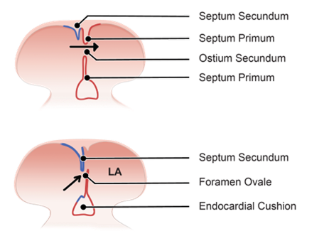 Figure 2-4. Formation of Septum Secundum and later, Foramen Ovale.