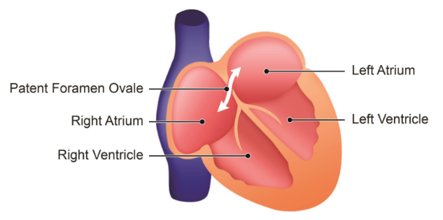 Figure 5-2. Patent Foramen Ovale.