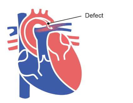 Figure 5-4. Patent Ductus Arteriosus.
