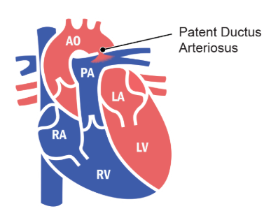 Figure 5-3. Ductus Arteriosus. 