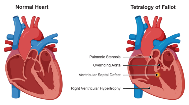Figure 2-6. Tetralogy of Fallot.