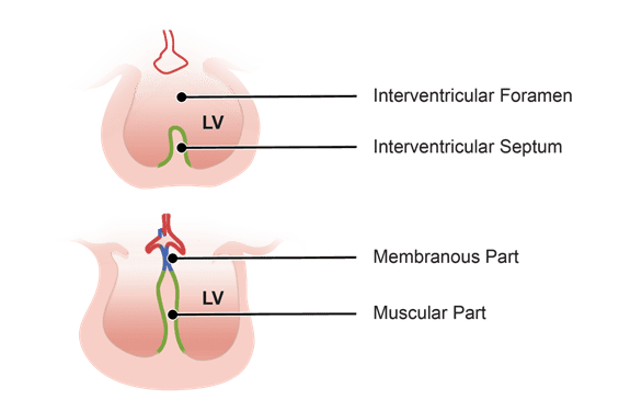 Illustration showing the interventricular septum of the heart, including the interventricular foramen, membranous part, and muscular part labeled in two simplified heart cross-sections.