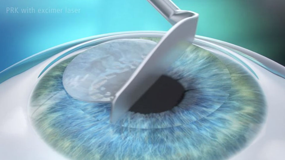 what is refractive error correction surgery