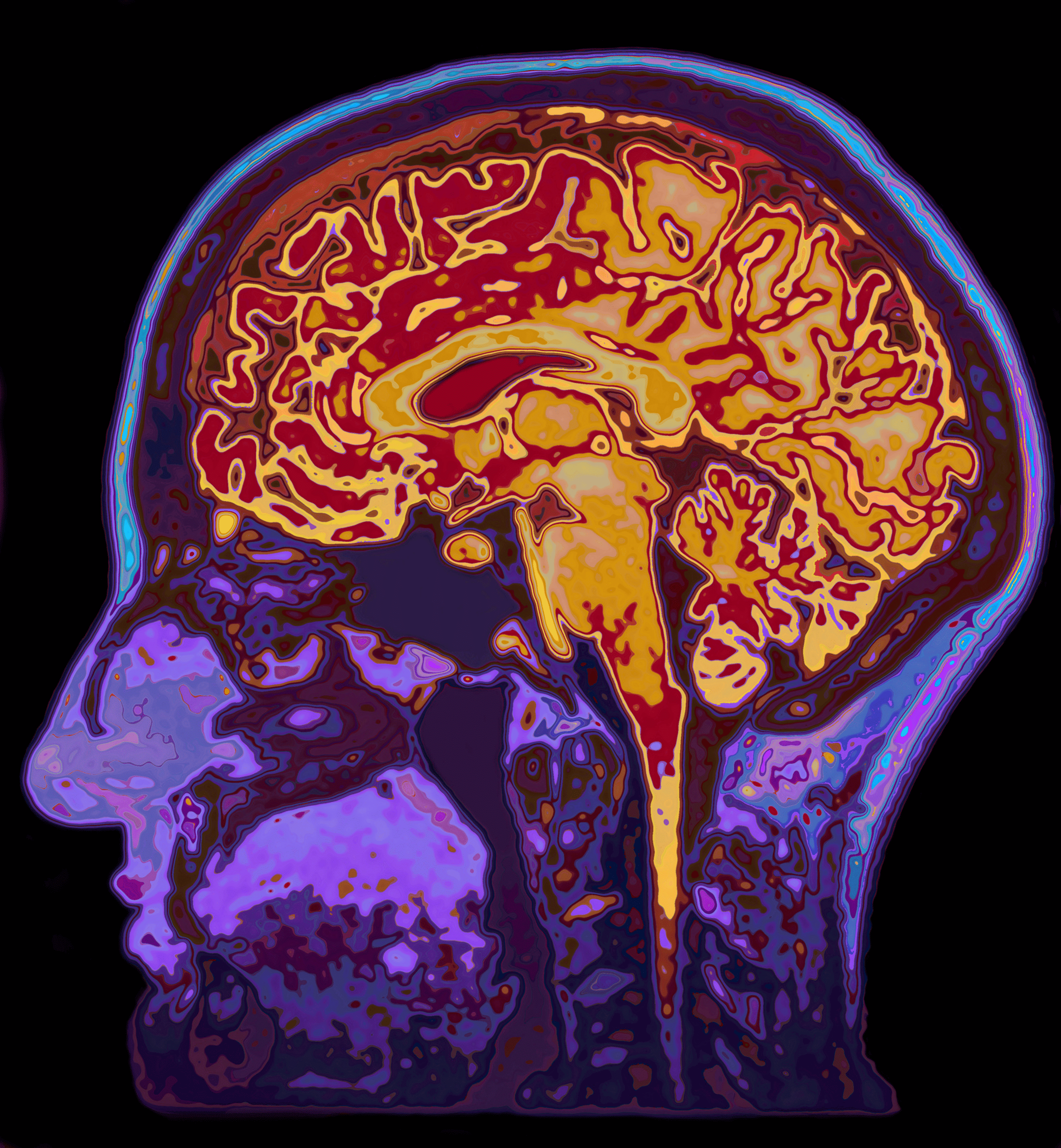 Precision Mental Health