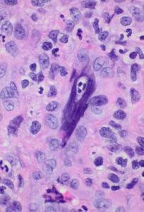 The Scream (of a neutrophil in an abscess)  by Dr Tan Hui Min