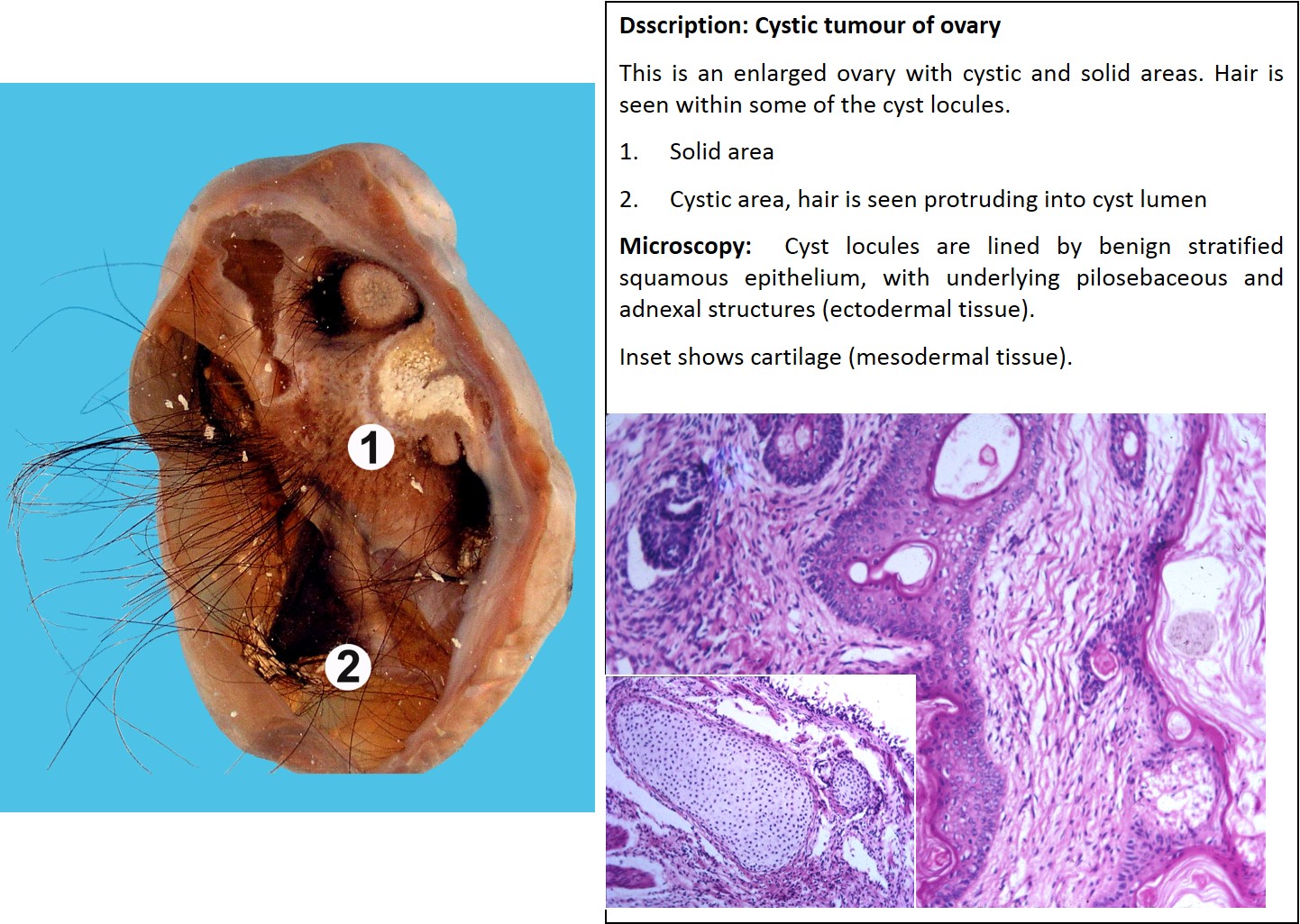 ovary-teratoma-gross-and-micro-annotated