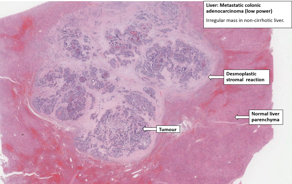 Liver – Secondary carcinoma – NUS Pathweb :: NUS Pathweb