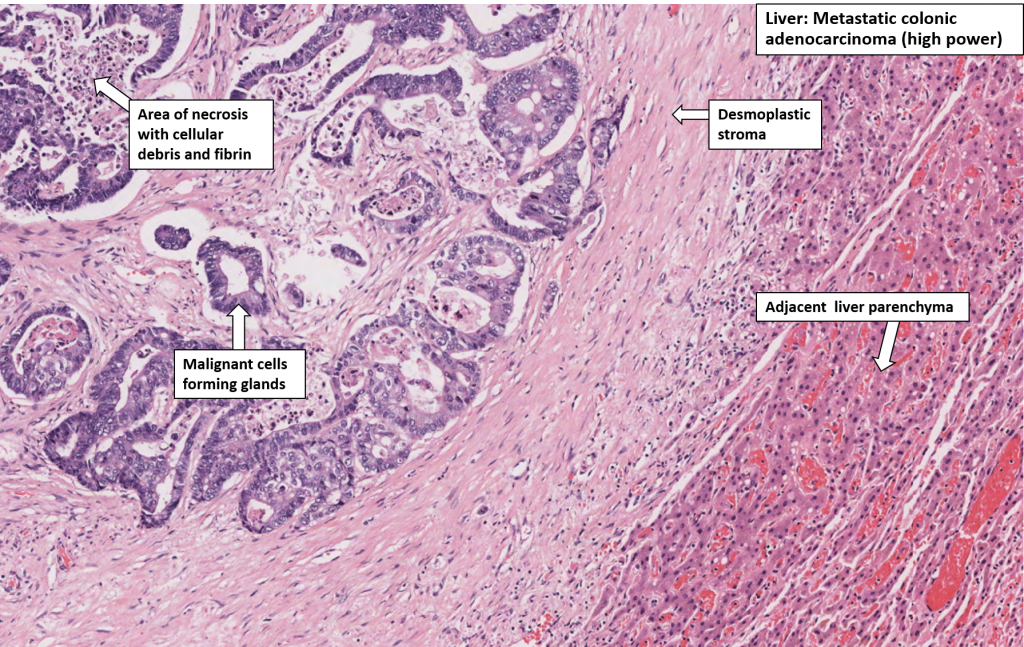 Liver – Secondary carcinoma – NUS Pathweb :: NUS Pathweb
