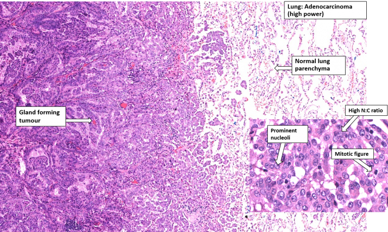 Lung – Bronchogenic Carcinoma – NUS Pathweb :: NUS Pathweb