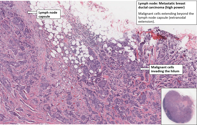 Breast Carcinoma With Lymph Node Metastases Nus Pathweb Nus Pathweb