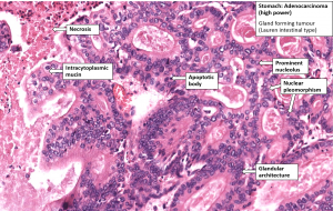 Stomach – Carcinoma – NUS Pathweb :: NUS Pathweb