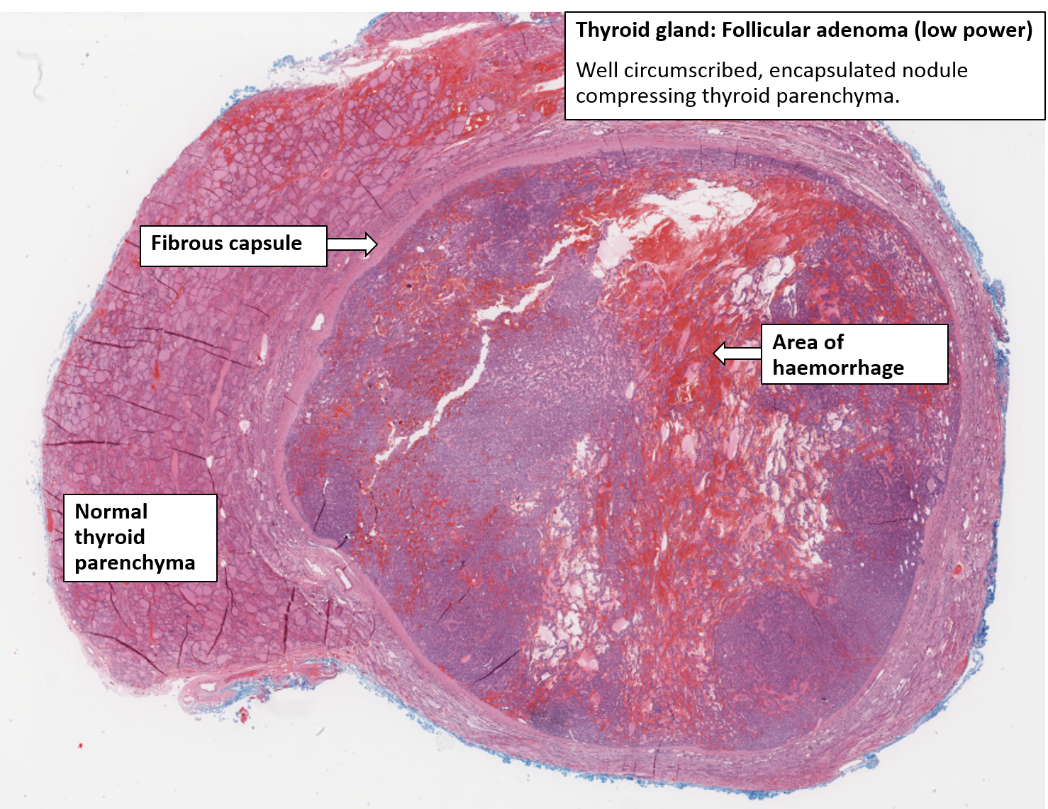 thyroid adenoma histology