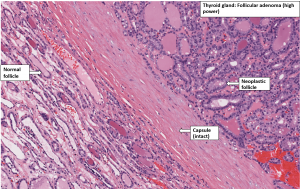 Thyroid – Follicular Adenoma – NUS Pathweb :: NUS Pathweb