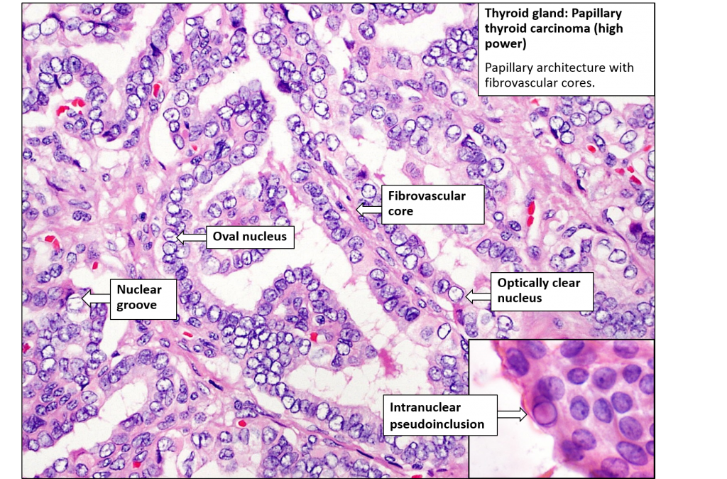 Thyroid – Papillary carcinoma – NUS Pathweb :: NUS Pathweb