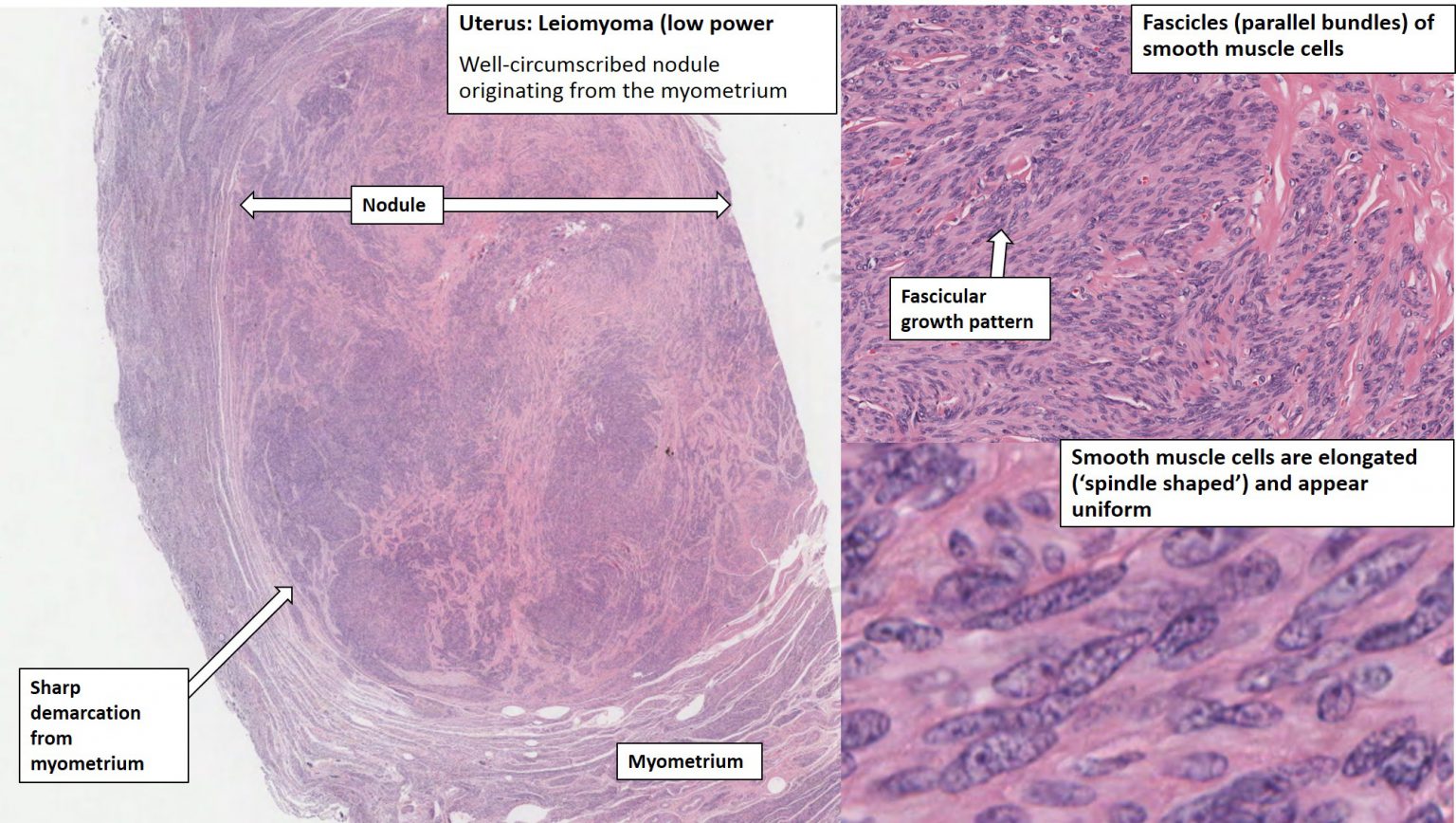 Uterus – Leiomyoma – NUS Pathweb :: NUS Pathweb