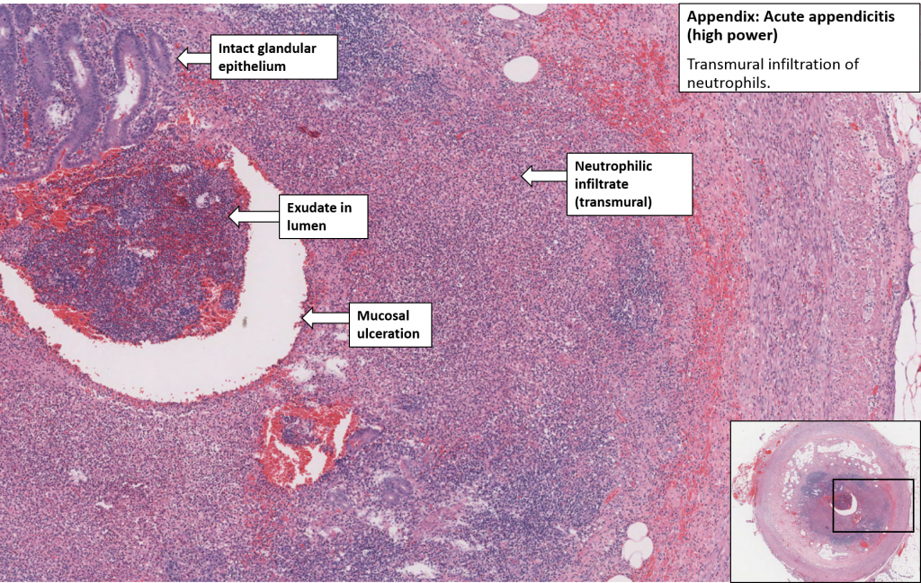 Appendix Acute Appendicitis NUS Pathweb NUS Pathweb Appendix Acute Appendicitis NUS Pathweb NUS Pathweb