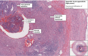 Appendix – Acute Appendicitis – NUS Pathweb :: NUS Pathweb