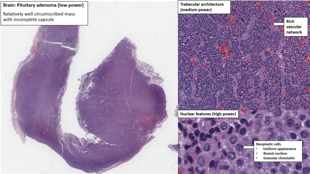 Pituitary Gland Adenoma Nus Pathweb Nus Pathweb 8101