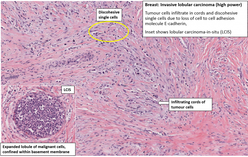 Диагноз in situ. Invasive ductal carcinoma гистология.