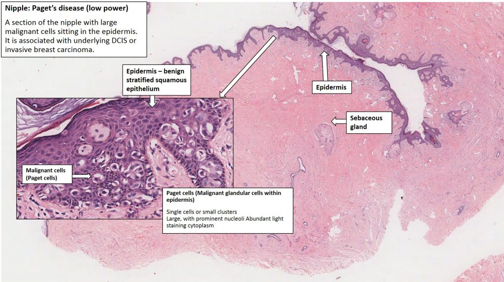 Breast Paget's Disease NUS Pathweb NUS Pathweb