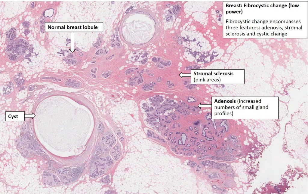 Breast Fibrocystic Disease Nus Pathweb