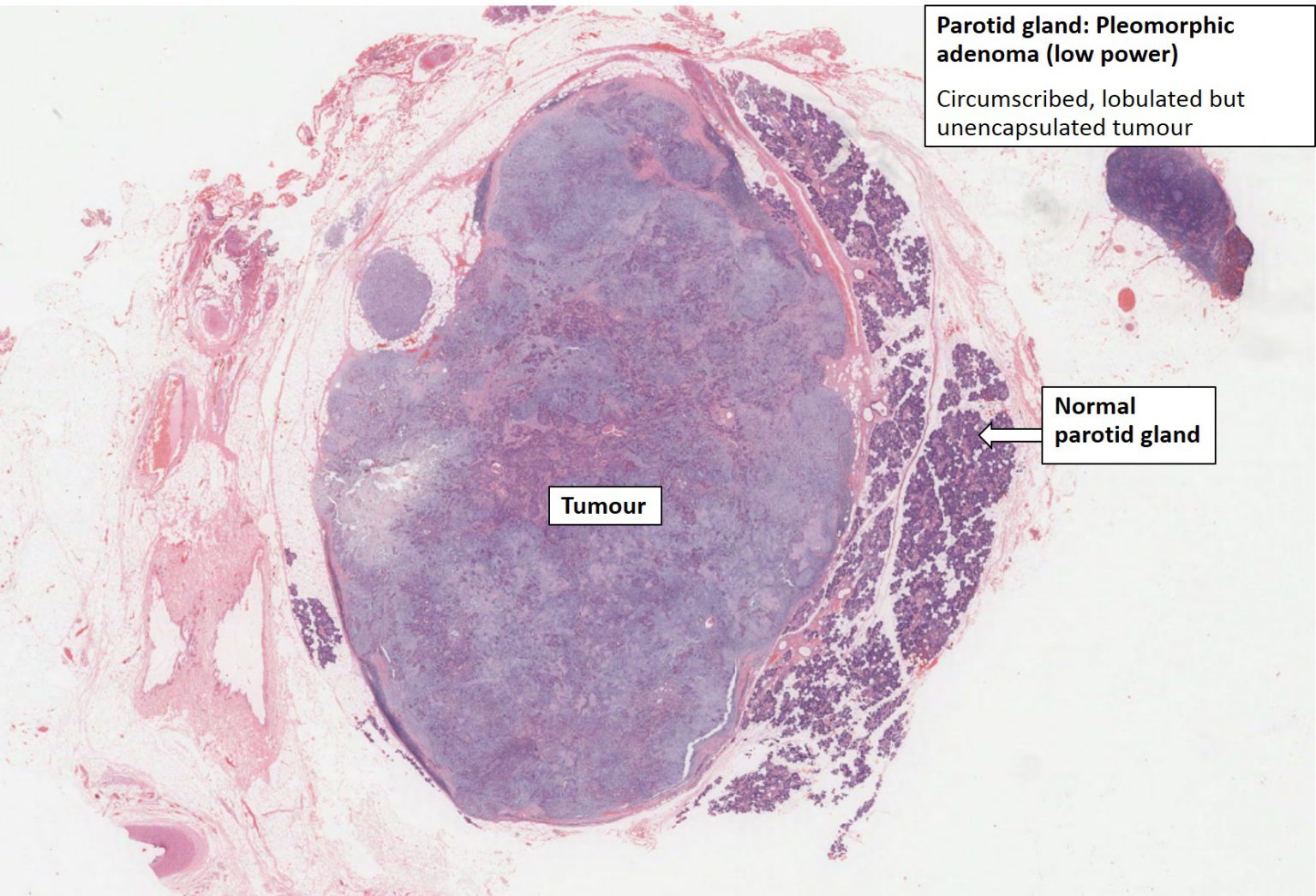 Salivary Gland – Pleomorphic Adenoma – NUS Pathweb :: NUS Pathweb