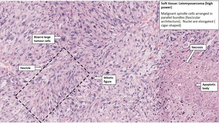 Thigh – Leiomyosarcoma – NUS Pathweb :: NUS Pathweb