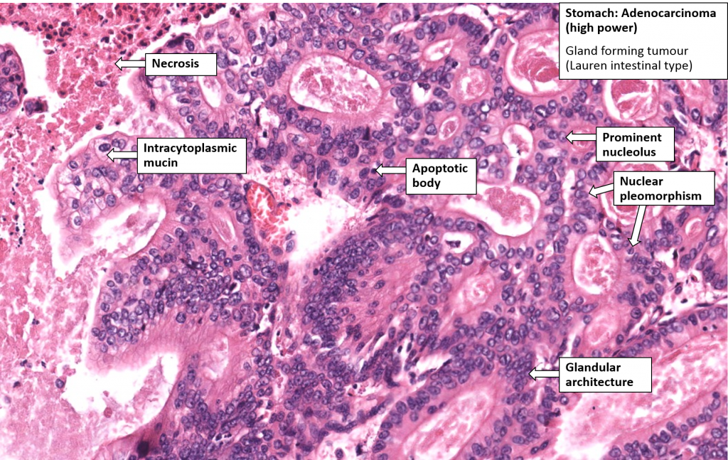 Stomach – Carcinoma (Linitis Plastica) – NUS Pathweb :: NUS Pathweb