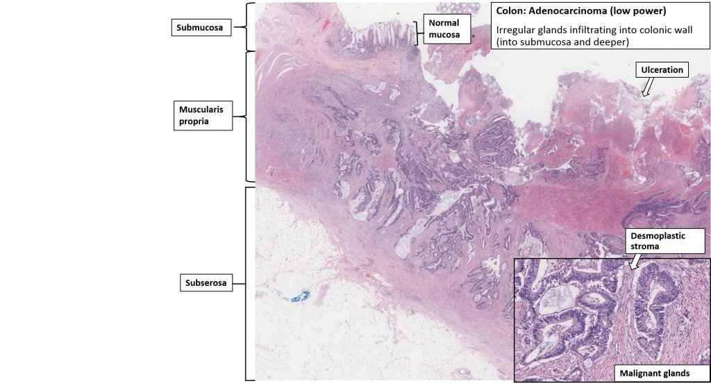 Adenocarcinoma Intestinal Diferenciado, Micrografia Leve Foto de Stock ...