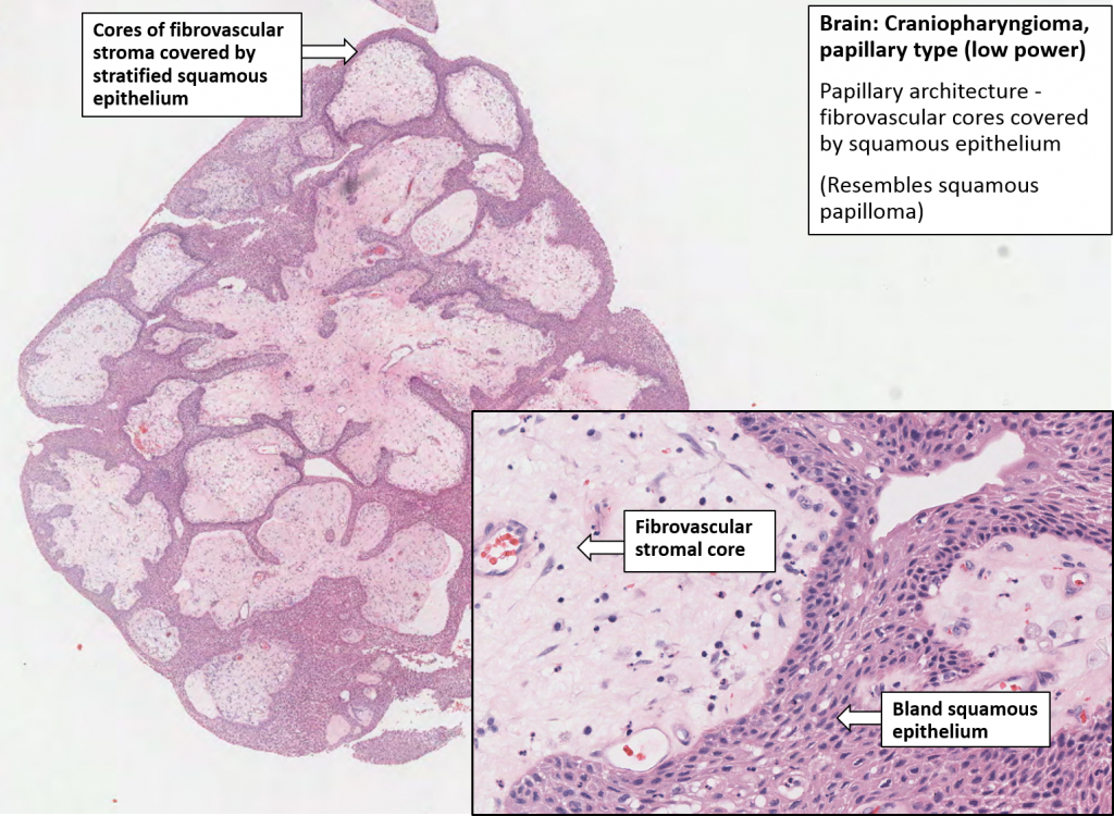 Brain – Craniopharyngioma – NUS Pathweb :: NUS Pathweb