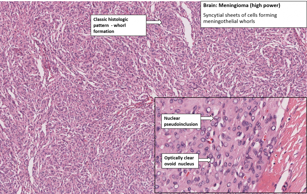 Brain – Meningioma – NUS Pathweb :: NUS Pathweb